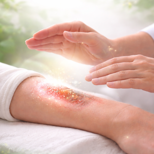 Wounds & Burn Healing